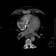 Ectopic pancreas, gigantic, pancreatic ectopia: CT - Computed tomography
